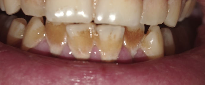 Günde 2 paket sigara ictigim için dişlerim çok kötü bir hale geldi. Dişlerimi nasıl beyazlatabilirim?