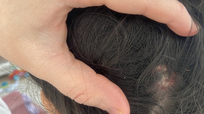 Saçlı deride seboreik dermatit yaşayanlar, azaltabilen var mı