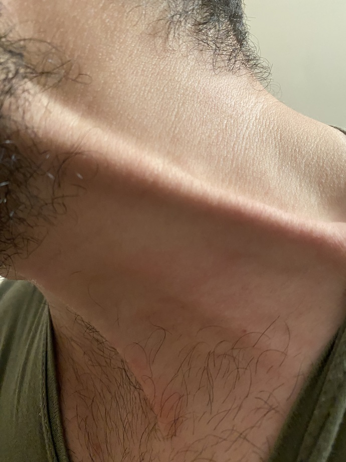 Boynumda 15 dk önce böyle bir damar çıktı ne damarı bu?