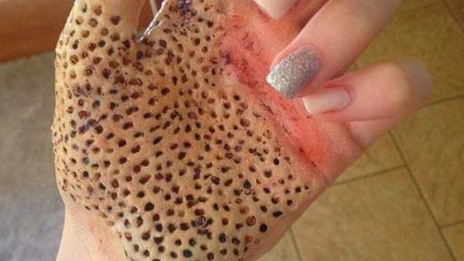 Delik fobisi olan var mı?