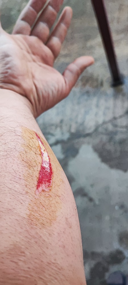 Kolumda açılan yara dikiş ister mi?
