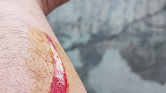 Kolumda açılan yara dikiş ister mi?