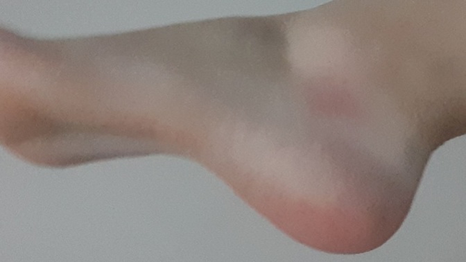 Ayağımı burktum, morarması normal mi?