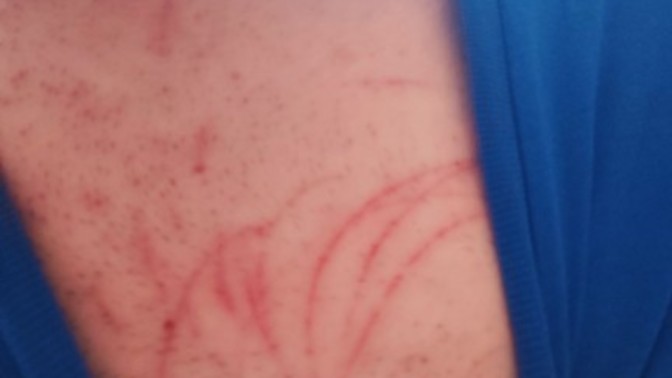 Kolumda ve göğsümde bunlar çıktı neden olur?