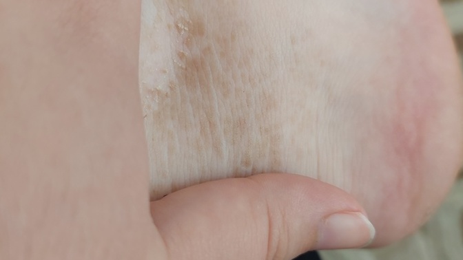 Ayak bileğim niye böyle leke oluyor ve nasıl çıkar?