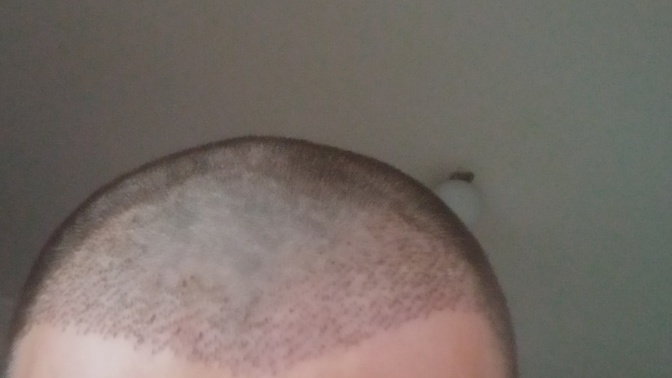 Sizce bu saç ekimi iyi mi kötü mü?