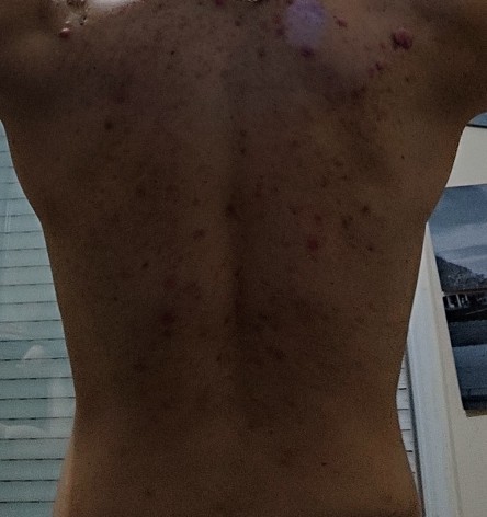 Göğüs, omuz ve sırtta sivilce ve keloid problemi nasıl çözülür?