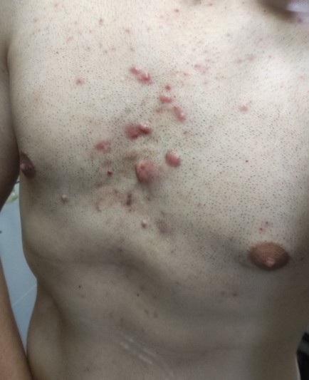 Göğüs, omuz ve sırtta sivilce ve keloid problemi nasıl çözülür?