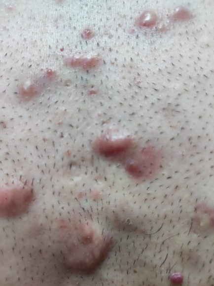 Göğüs, omuz ve sırtta sivilce ve keloid problemi nasıl çözülür?