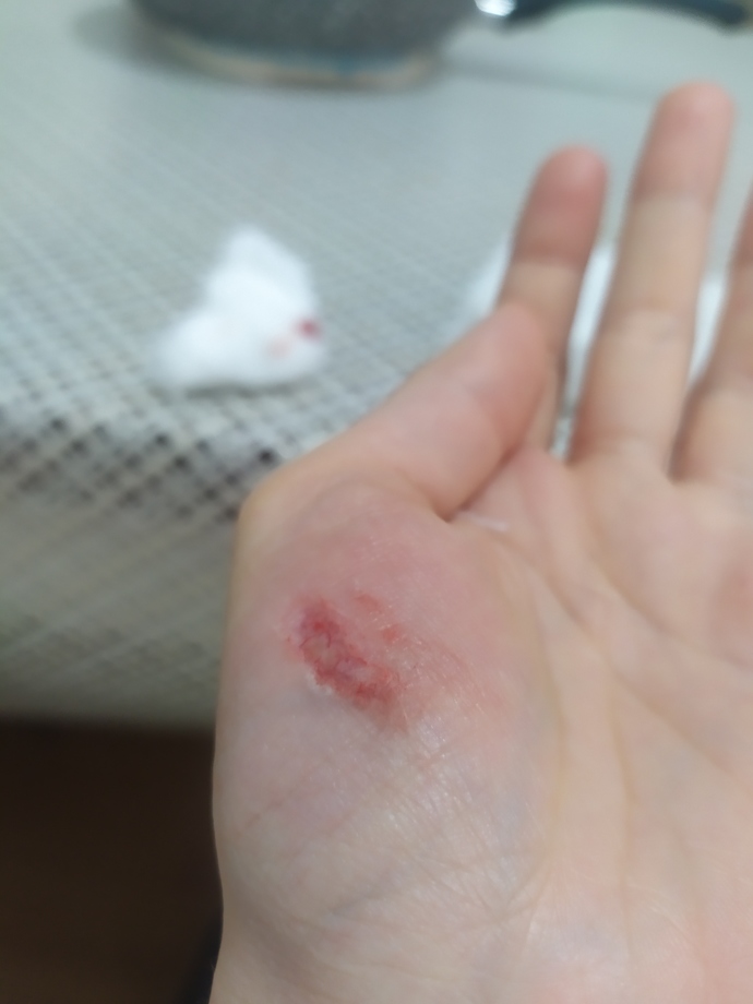 Elime dikiş atılması gerekir mi (resimli)?