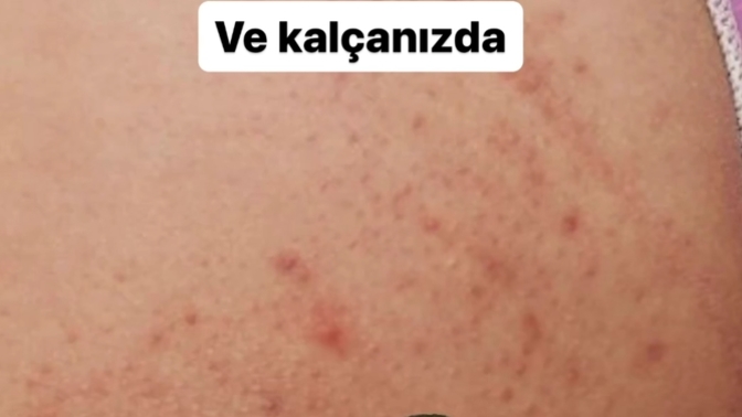 Kızlar, Kalça ve sırt sivilceler yardım lütfen?