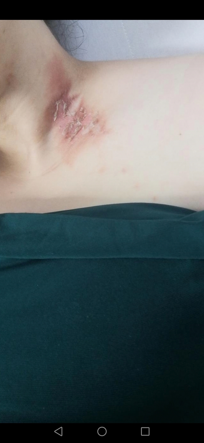 Pembe olan şuanki halı, bu ikinci attığım fotoğraf kızarıklığın dördüncü günüydü. İki hafta geçti üzerinden