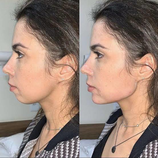 Bir yerde okumuştum erken yaşta jawline sarkma vs. yapiyormus diye sizce yapilabilir mi?