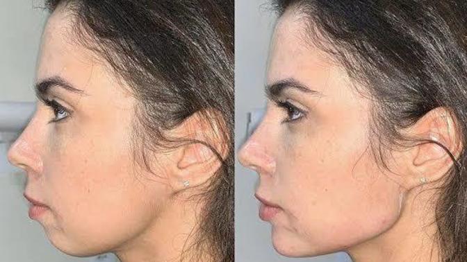 Erken yaşta jawline zararlı mı?