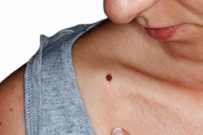 Vücudundaki benleri bir kusur olarak mı görürsün yoksa sever misin?