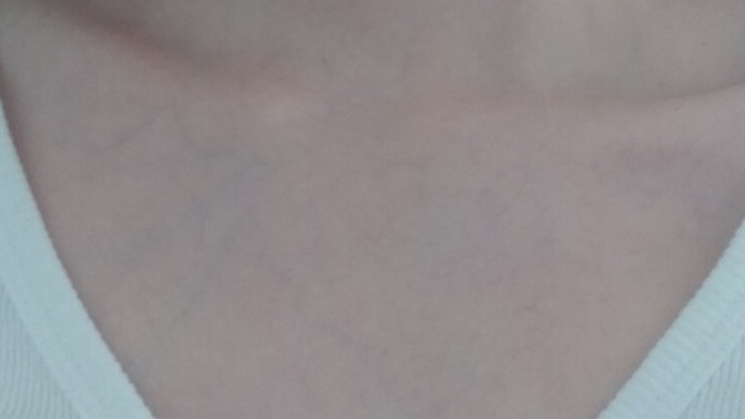 Kılcal damarlarım çok belirgin, nasıl geçer?