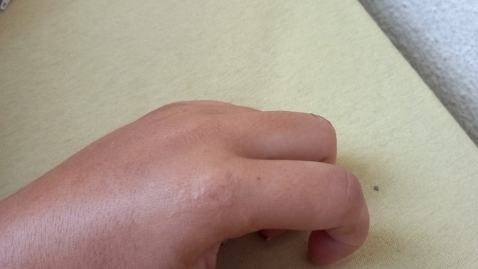 Elimde lekelenme, kaşıntı ve renk değişikliği var. Sebebi ne olabilir?