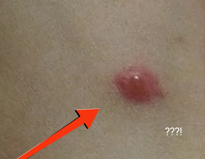 Aşağıda Fotoğraftaki Sivrisinek Isırığı Neden Böyle Olduyor?