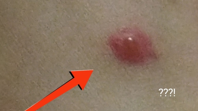 Aşağıda Fotoğraftaki Sivrisinek Isırığı Neden Böyle Olduyor?