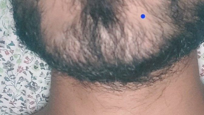 Lazer yapılır mı?