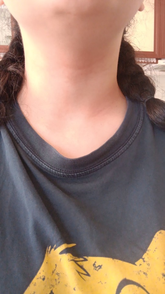 Terden boynum kızarıyor, hiçbir şey süremiyorum. Nasıl geçer?