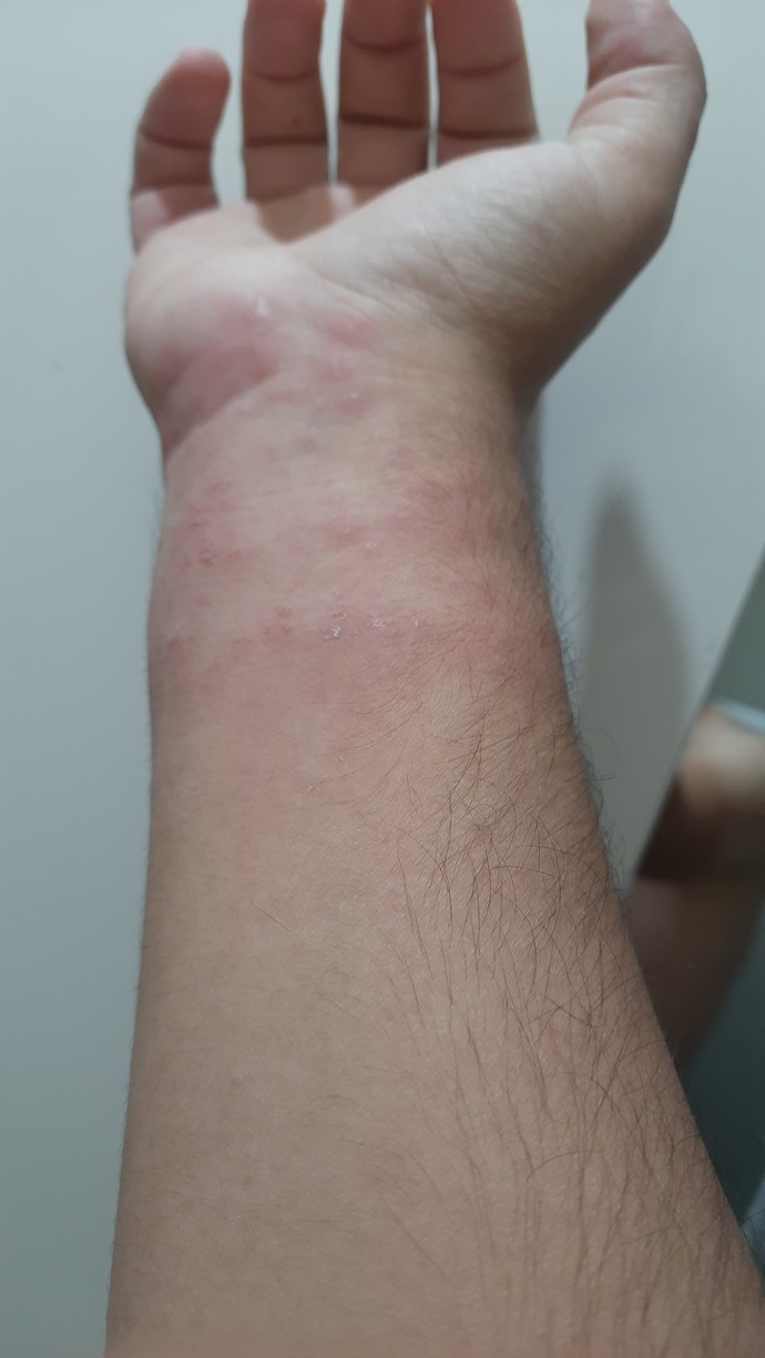 Geçen bir gecelik bir yerde konakladım, vücudumda böyle bir şeyler oldu. Nasıl geçer?