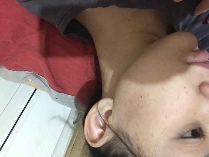 Yüzümdeki renk eşitsizliği ve sivilce lekelerini nasıl giderebilirim?