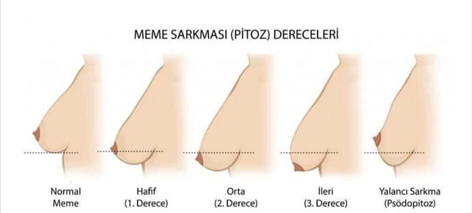 Göğüs sarkması neden olur?