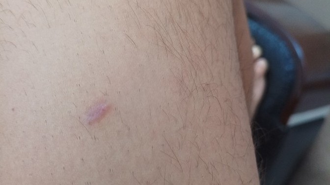 Bu yara enfeksiyon kapmış mı?