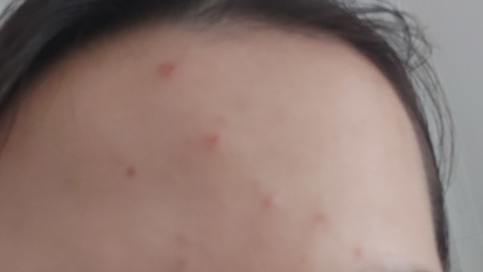 Sivilce için önerdiğiniz bir krem var mı?