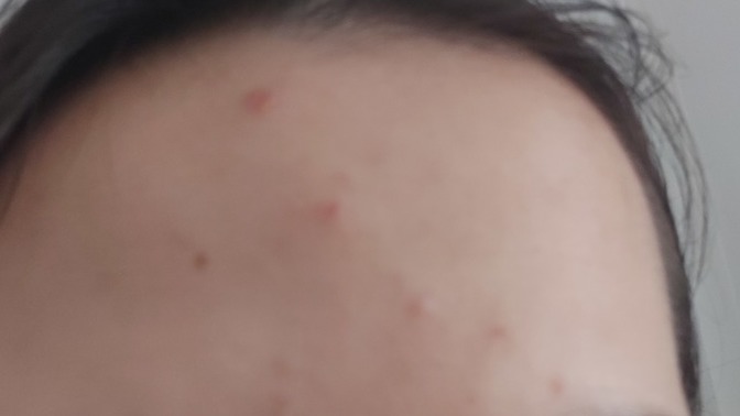 Sivilce için önerdiğiniz bir krem var mı?