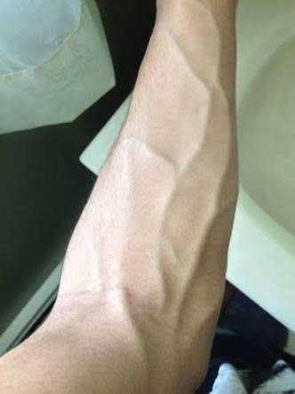Spor yaparken kollarımdaki damarlar bu hale geliyor normal mi?