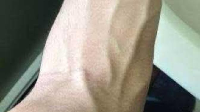 Spor yaparken kollarımdaki damarlar bu hale geliyor normal mi?