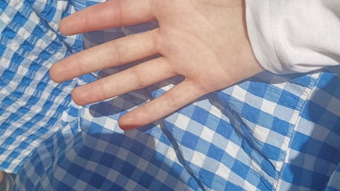 Arının iğnesini batırdığı yer neden kaşınır?