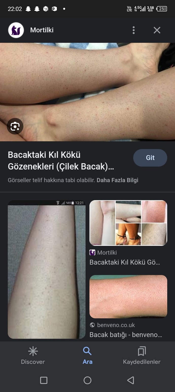 Bacaktaki batıklar nasıl geçer?