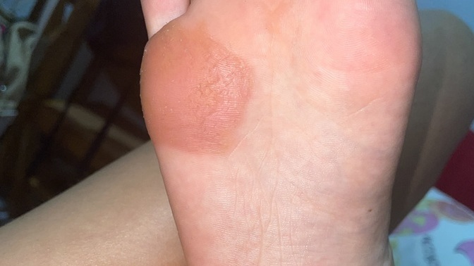Ayak nasırıma bakar mısınız nasıl geçecek?
