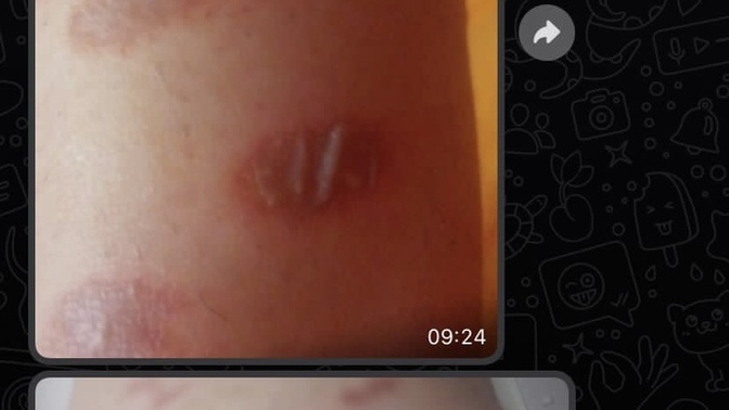 Su toplayan lazer epilasyon yanığına hangi krem iyi gelir, ne yapılması gerekir?