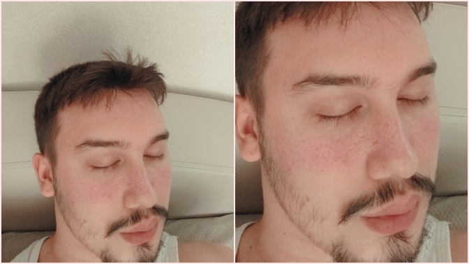 Burnumu yaptırmayı düşünüyorum, sizce gerek var mı?