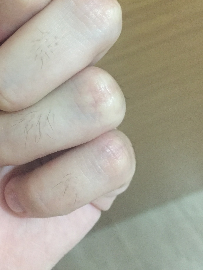 Parmak boğumlarında neden kıl olur, ağdayla alıyorum nokta nokta duruyor jiletle de öyle mi olur?