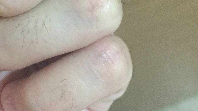 Parmak boğumlarında neden kıl olur, ağdayla alıyorum nokta nokta duruyor jiletle de öyle mi olur?