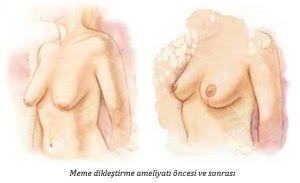 20 yaşında memelerim sarkmış neden böyle oldu? aşırı kilo vermedim, doğum yapmadım boy 159 kilo 59?