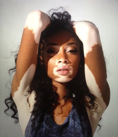 Winnie Harlow