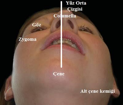 Asimetrik yüz nasıl düzelir çözümleri nelerdir?