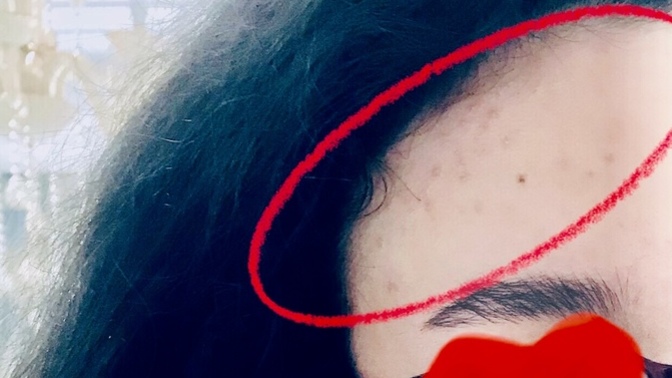 Sivilcelerimi azaltacak veya söndürecek tavsiyeleriniz var mı?