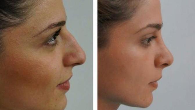 Burun estetiği olacak parayı size versem, burun estetiği olur muydunuz?