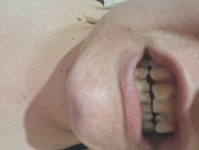 Bu ibretliklere kaplama yapılınca 4 diş sığmaz gibi geliyor, kesici dişlerin çekilmesi gerekir mi?
