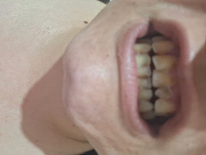 Bu ibretliklere kaplama yapılınca 4 diş sığmaz gibi geliyor, kesici dişlerin çekilmesi gerekir mi?