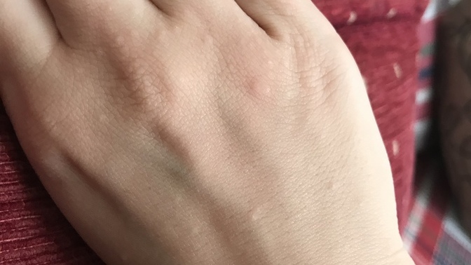Ciltte kabarcık ve kaşıntı problemi yaşayıp hastaneye gitmiş olan var mı, çözümü nedir?