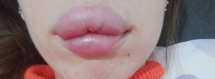 5 saat önce 1 cc dolgu yaptım. Böyle olması normal mi?