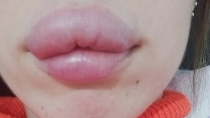 5 saat önce 1 cc dolgu yaptım. Böyle olması normal mi?
